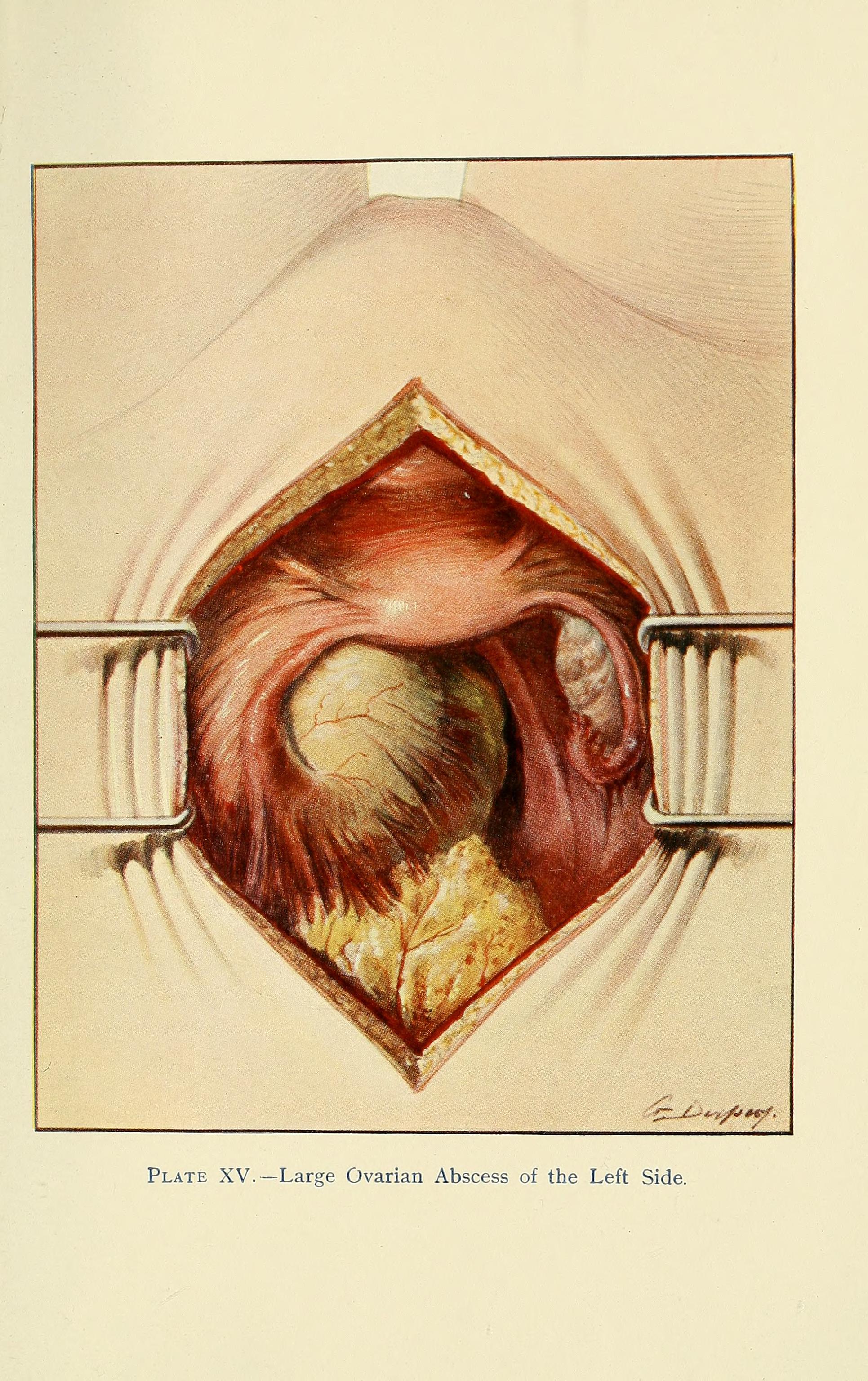 Eine medizinische Abbildung eines großen Eierstockabszesses auf der linken Seite mit beschreibendem Text unten.